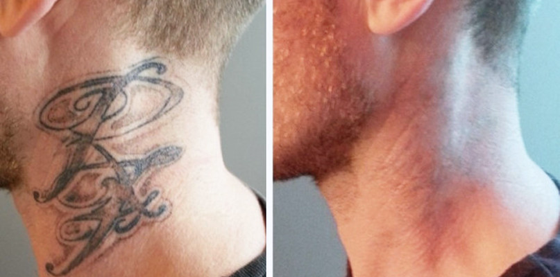 Oto Q-Switch - sposób na niechciany tatuaż!