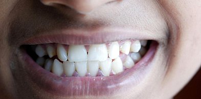 Twoje dziąsła mogą wpływać na serce – groźny związek, o którym nie wie większość..