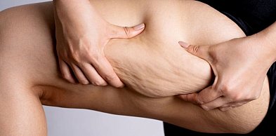 Na czym polega liposukcja ultradźwiękowa i czym różni się od klasycznej